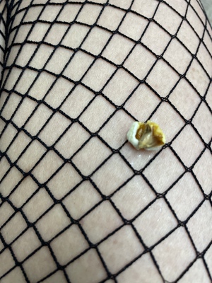 あこ